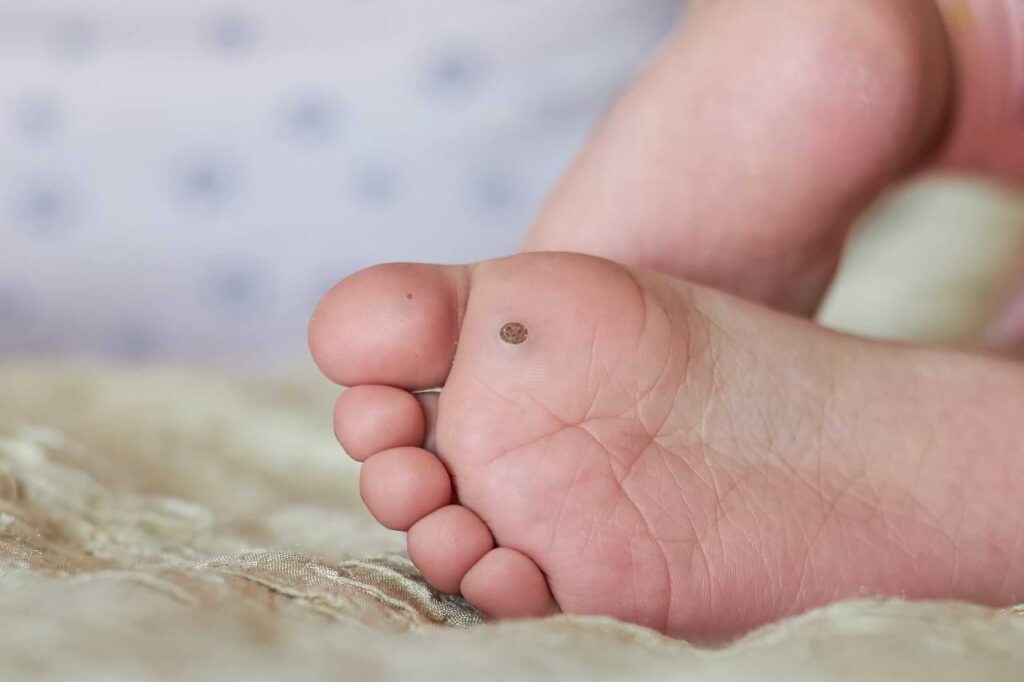 טיפול ביבלות בילדים: איך להיפטר מהן בבטחה? | פרופ' חיים ראובני