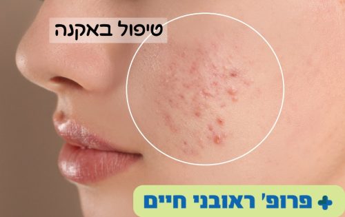 טיפול באקנה